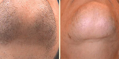 laser-hair-removal-by-beauty-device-1.webp