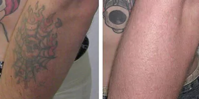 laser-tattoo-removal-by-nd-yag-laser-1.webp